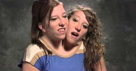 conjoined twins porn|Joined the Siamese Twins